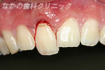 歯が折れた状態