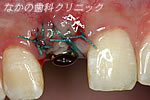 インプラント埋入