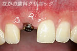インプラント埋入後1ヶ月